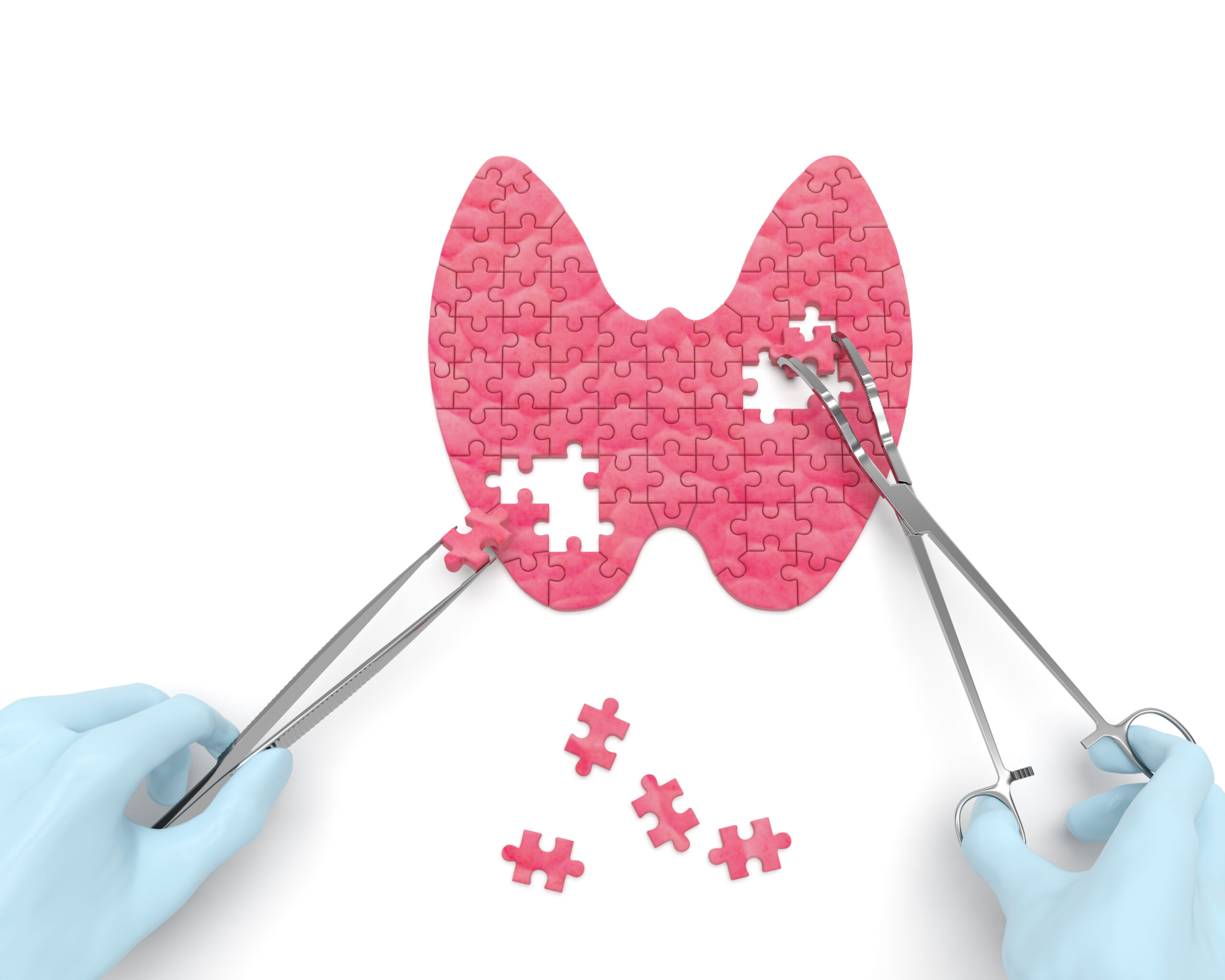 Treating Hypothyroidism in Adults: A Systematic Review and Quality Appraisal of Clinical Practice Guidelines Using AGREE II and AGREE-REX